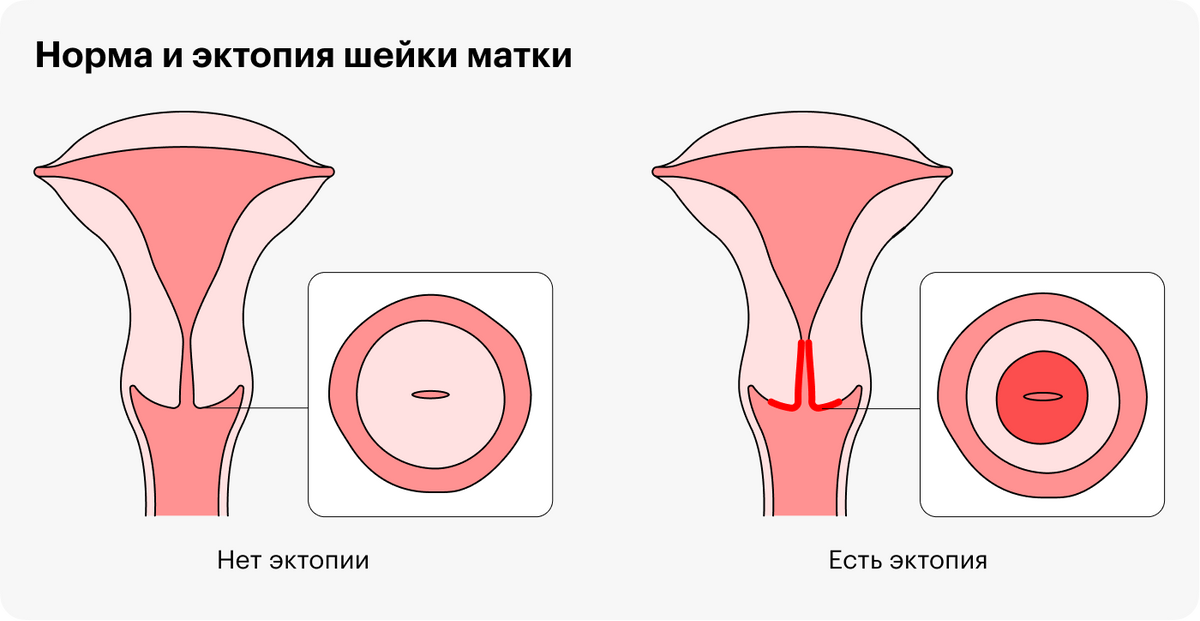Эктопия шейки матки — нормальное состояние, которое обычно не надо лечить