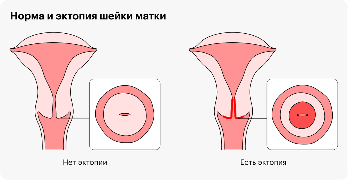 Схема лечения ВПЧ