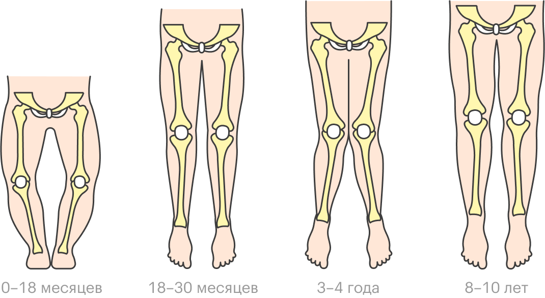Обычно О-образная и Х-образная деформация ног — варианты возрастной нормы, и положение ног выправится само по себе