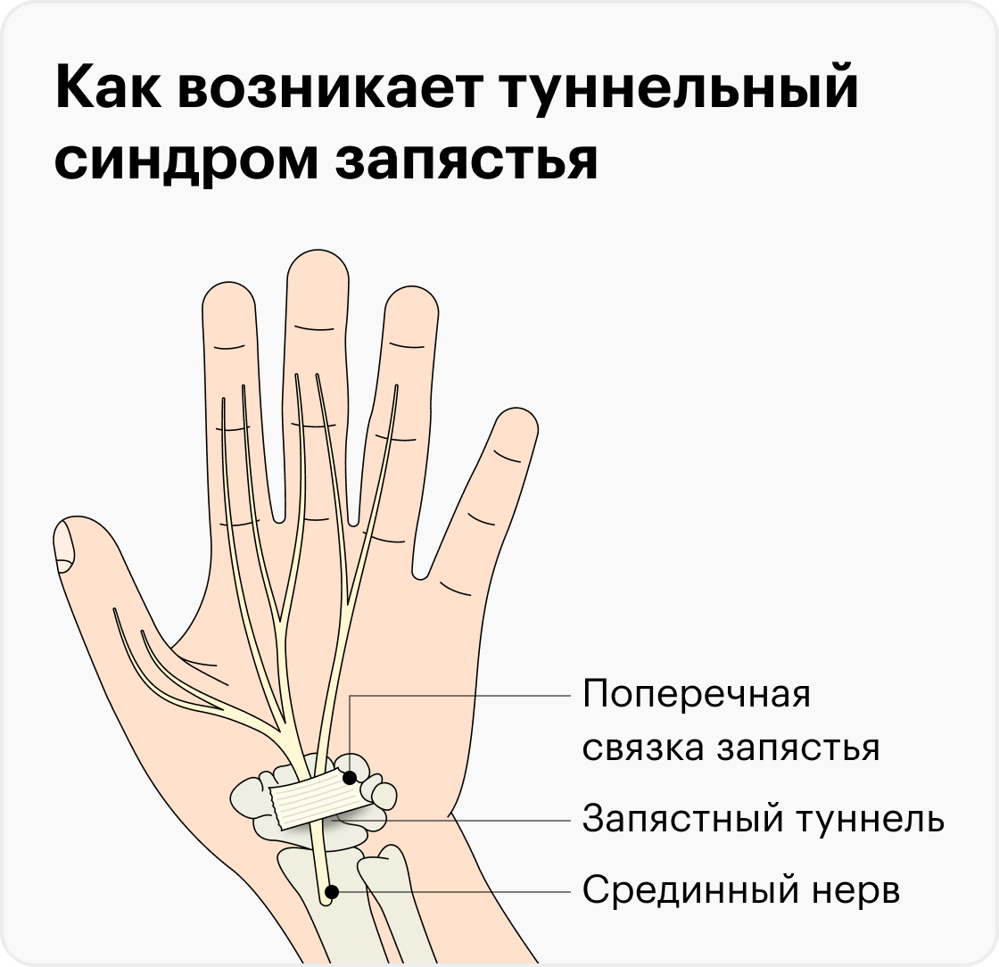 Синдром запястного канала. Лучезапястный синдром. Туннельный синдром запястья кисти.