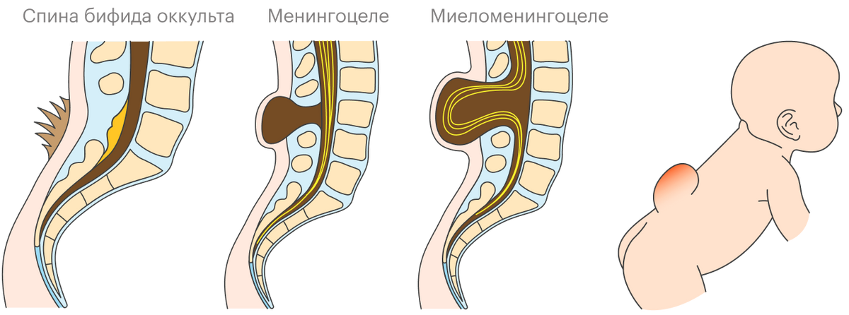 Так выглядят три самых распространенных формы спина бифида. Видно, как в зависимости от степени расщепления позвоночника спинной мозг и нервы развиваются внутри или вне&nbsp;тела — на наружной части спины