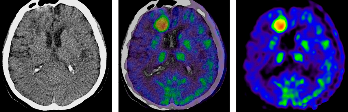 Слева — компьютерная томография мозга, справа — данные позитронно-эмиссионной томографии. На КТ врач не видит патологические очаги, накапливающие радиоактивное вещество. На ПЭТ/КТ они хорошо видны, но непонятно, где именно в мозге они расположены. Совмещая два исследования, можно точно определить расположение и размер очагов. Источник: adrad.com