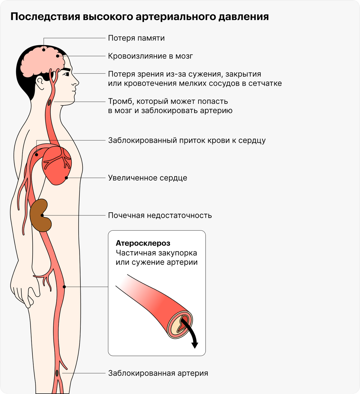 Гипертоническая болезнь стол 10