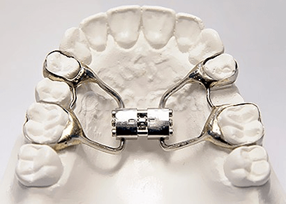 Так выглядит расширитель челюсти — дистрактор. Источник: dentalmagazine.ru