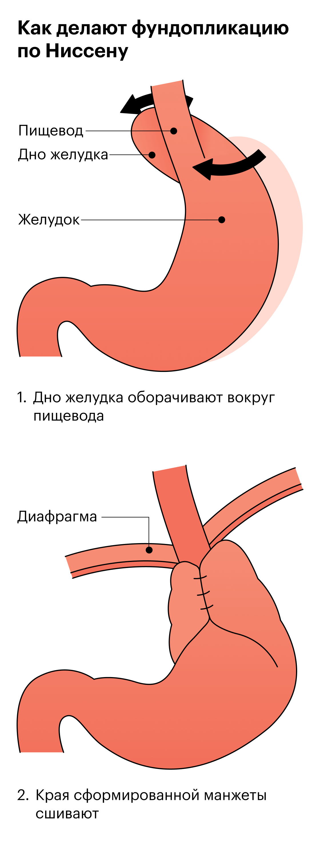 «Горло будто сжимают изнутри»: как операция на желудке помогла мне ...