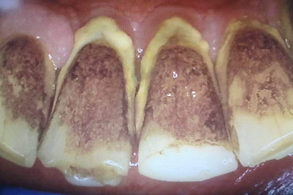 Как выглядит пародонтит на зубах фото