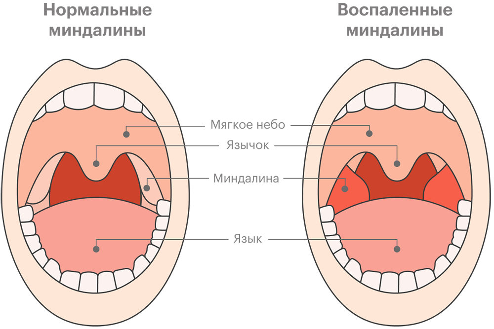 Строение горла миндалины. Миндалины у детей строение.