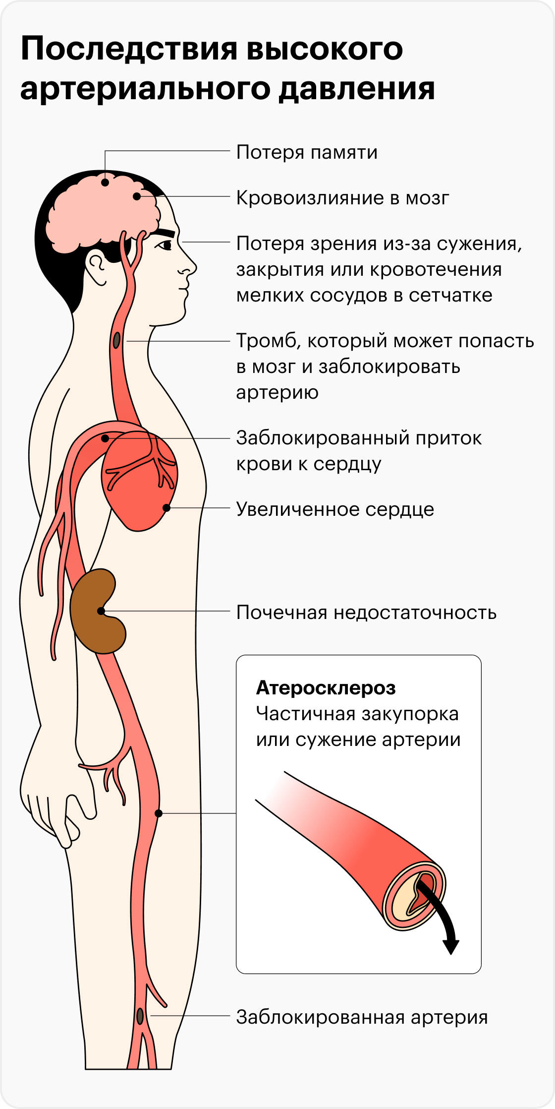 Гипертоническая болезнь стол 10