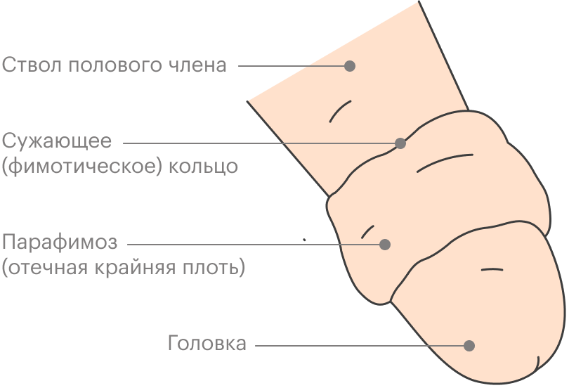 Крайняя плоть мера