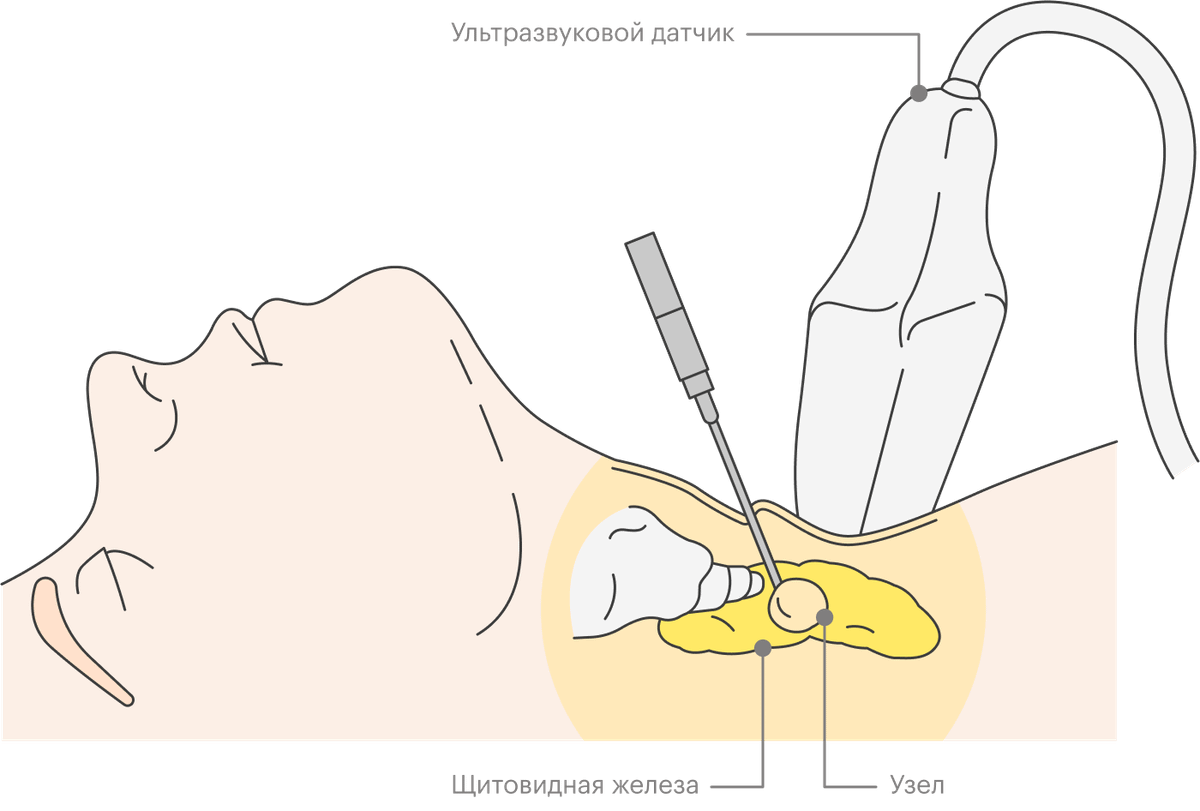 Биопсия у мужчин как делается. Пункционная биопсия щитовидной железы. Пункция (биопсия) щитовидной железы. Пункция узла щитовидной железы. Тонкоигольная аспирационная пункционная биопсия.