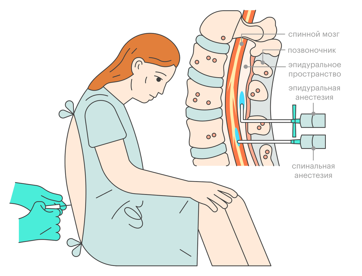 Схема эпидуральной анестезии