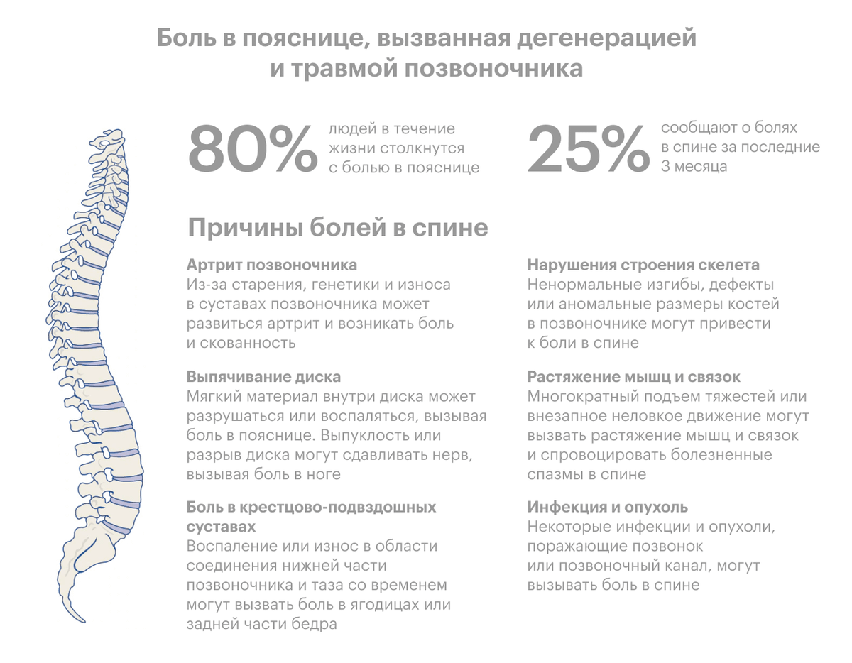 Основные причины болей в спине, по мнению сотрудников Клиники Майо