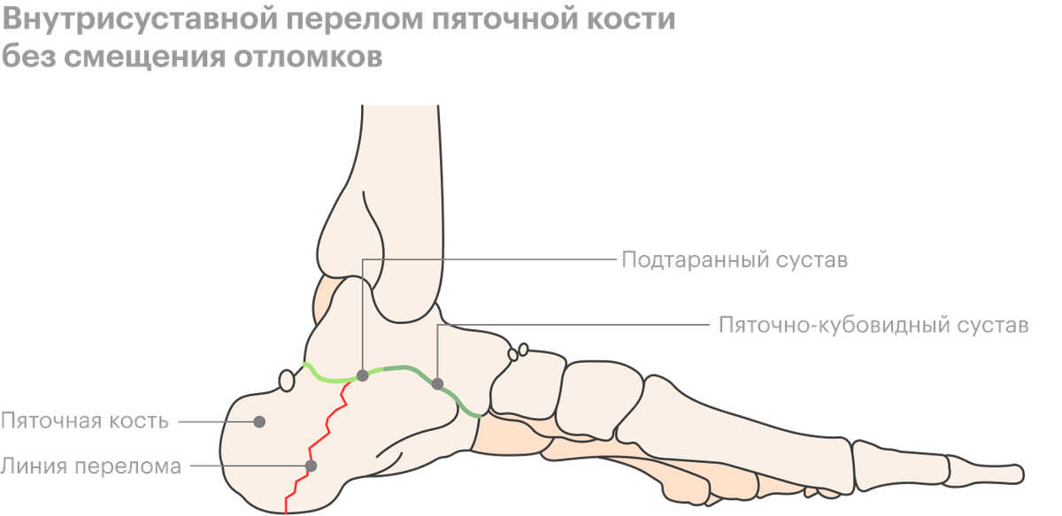 Краевой перелом таранной кости