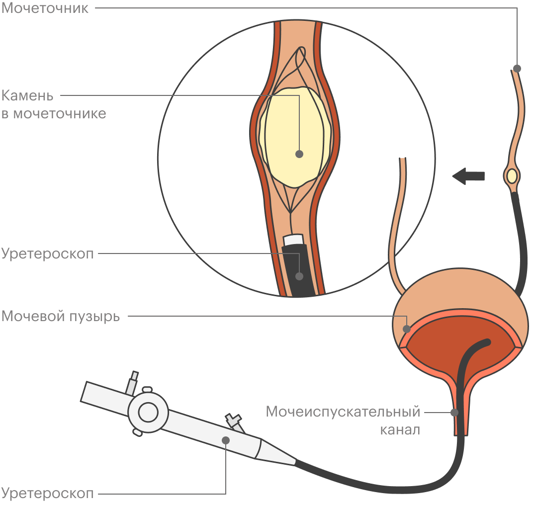 Пузыря мочеточников мочеиспускательного канала. Камень в мочеточнике уретероскопия. Камень в мочеточнике у женщин. Стенд катетер для мочеточника. Дробление камня в мочеточнике через уретру.