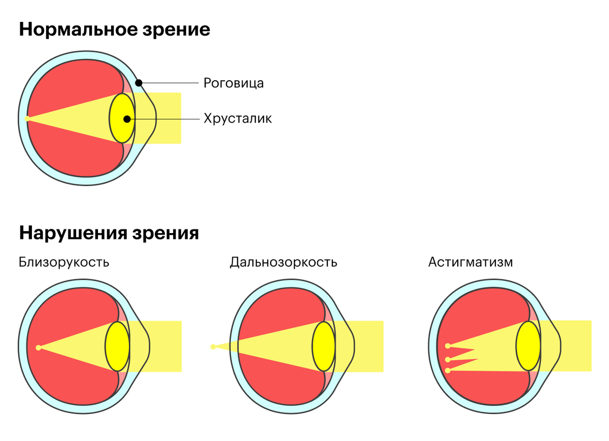 Изображение фокусируется за сетчаткой при