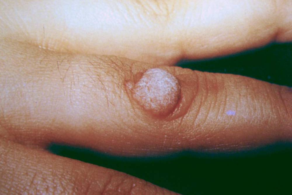 Папиллома: как передается вирус ВПЧ, насколько он опасен и можно ли ...