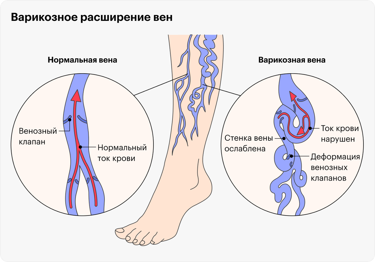 вариуозно оксширенные вены нижрих кон. варикоз схема. расширенные вены нижних конечностей. варикозное расширение вен на ногах. перфорантные вены нижних конечностей.