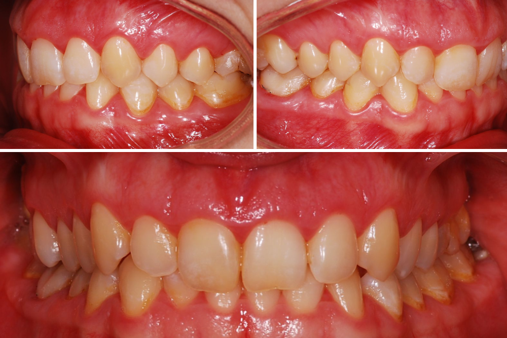 Пациент с ровными зубами и глубоким прикусом, а также биретрузией резцов, то есть их расположением слишком глубоко за другими зубами