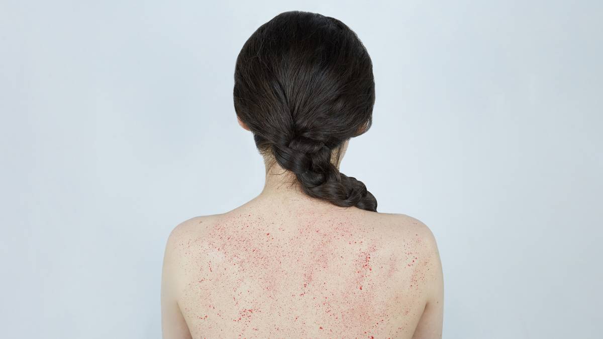 Что такое идиопатическая тромбоцитопеническая пурпура