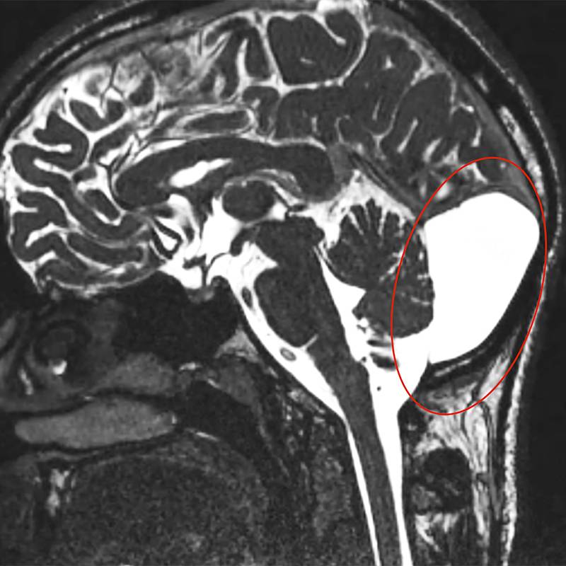 Вот как может выглядеть арахноидальная киста на&nbsp;мозжечке. Этот снимок я взяла из&nbsp;интернета — мой&nbsp;потерялся. Источник: Radiopaedia.org