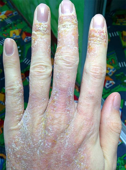 Экзема: причины, лечение, диагностика, как выглядит, экзема на руках ...