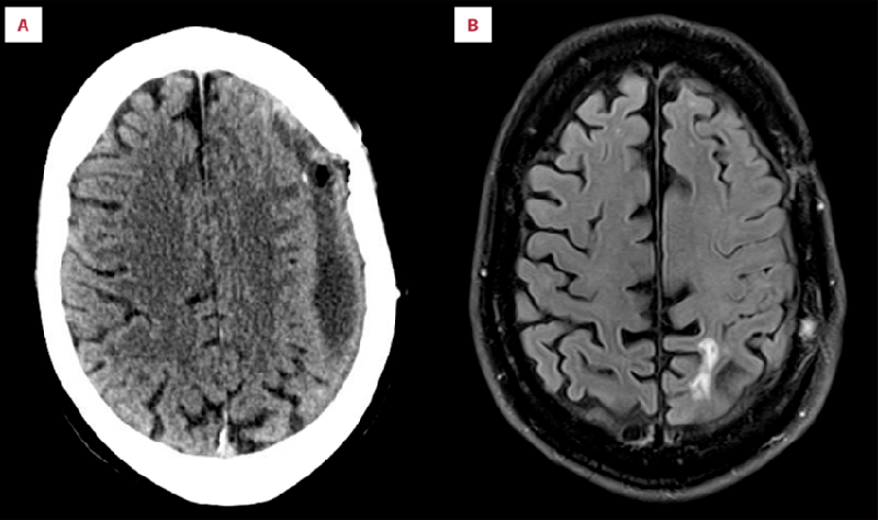 Слева — головной мозг на компьютерной томографии, справа — на магнитно-резонансной томографии. Источник: researchgate.net