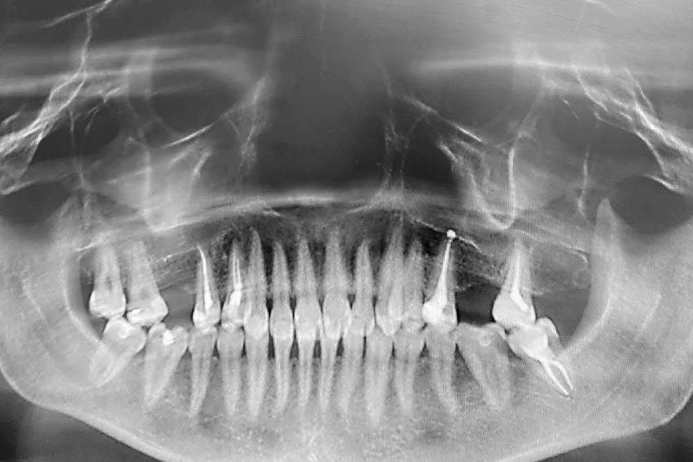 Рентген челюсти фото