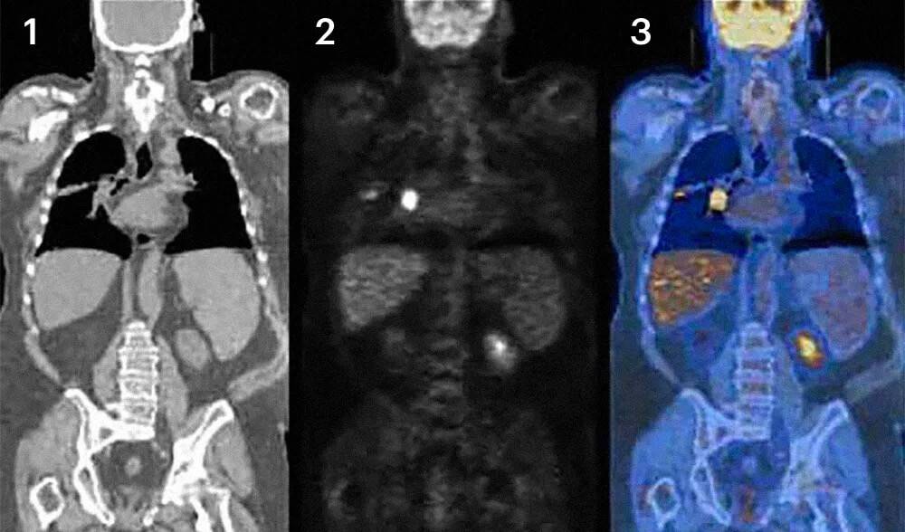 При&nbsp;ПЭТ-КТ совмещают изображения, полученные с помощью обычной компьютерной томографии (1) и позитронно-эмиссионной томографии (2), которая показывает уровень обмена в клетках: у раковых клеток он повышен, они видны в виде ярких очагов. На совмещенном снимке (3) хорошо видны внутренние органы, а яркий очаг в груди — это рак легкого. Источник: Клиника Майо