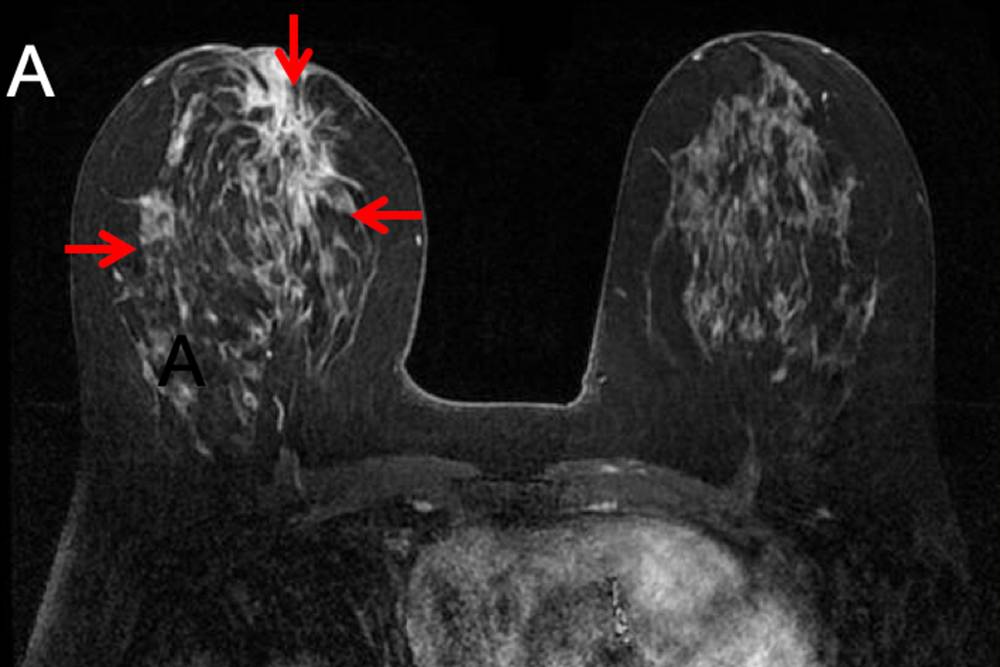 Так может выглядеть опухоль молочной железы на МРТ. Источник: lobularbreastcancer.org
