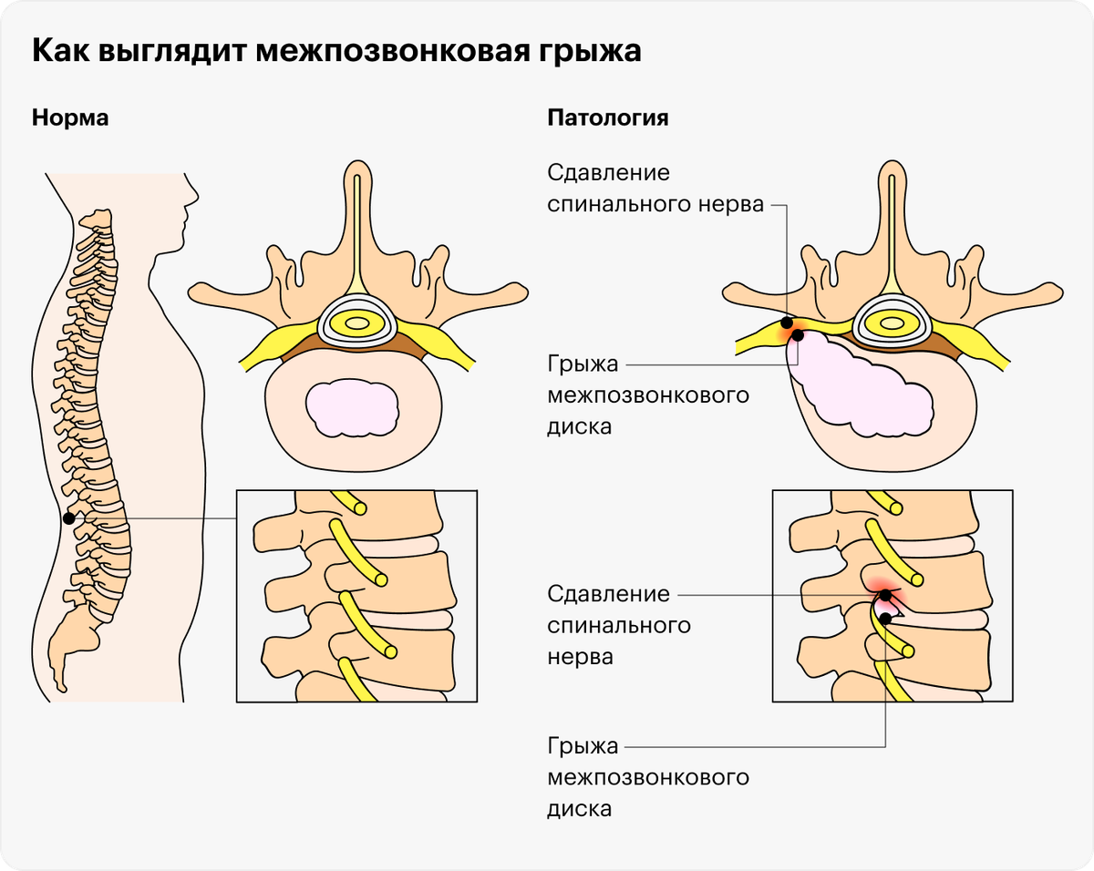 Поясничная грыжа лечение отзывы форум. Грыжа межпозвонкового диска. нервные корешки поясничного отдела. грыжа позвоночника размеры. межпозвонковые нервы.
