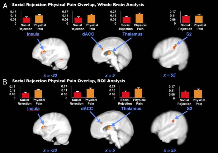 На изображении — области мозга, которые активируются и при отвержении, и при физической боли. Графики иллюстрируют, насколько интенсивна активация той или иной области в каждом случае. Источник: pnas.org