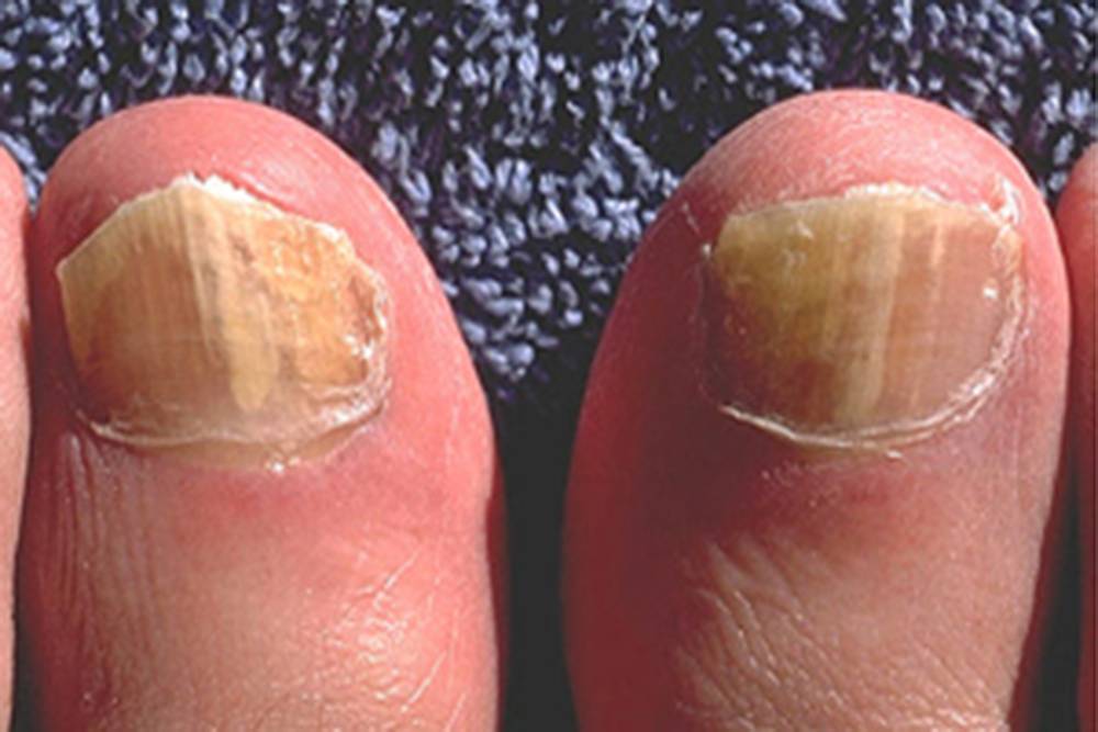 Чаще всего встречается подногтевой онихомикоз большого пальца ноги. Источник: cdc.gov