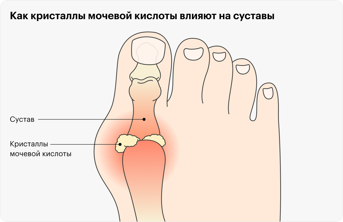 Стол при подагре и повышенной мочевой