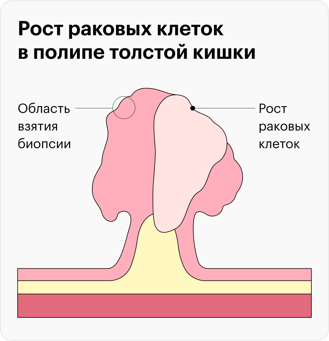 Сколько стоит колоноскопия в Израиле