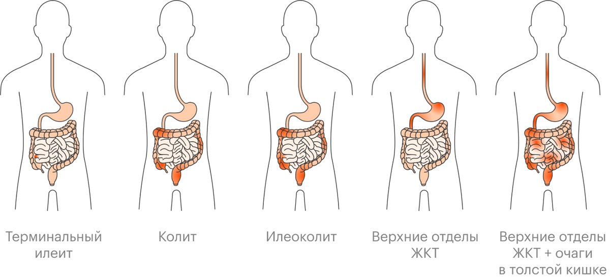 Поражение разных отделов желудочно-кишечного тракта при&nbsp;болезни Крона
