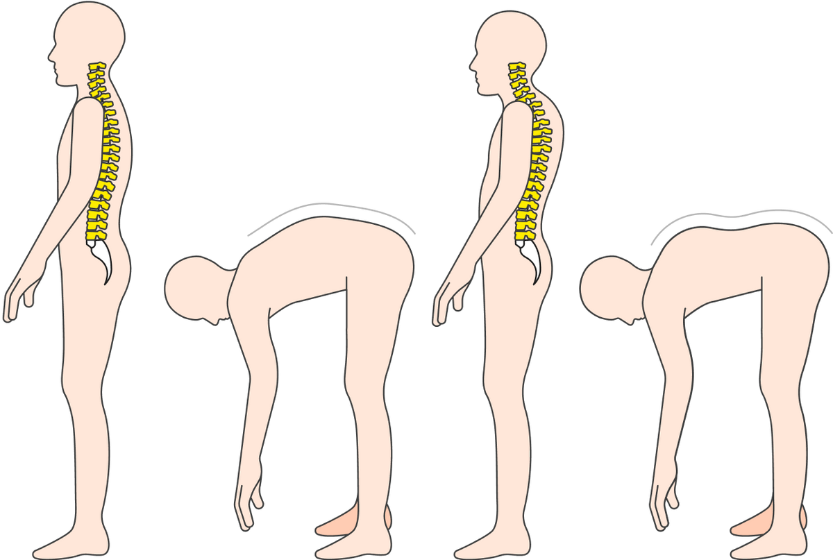 Грудной кифоз тоже видно по искривлению спины стоя и в наклоне