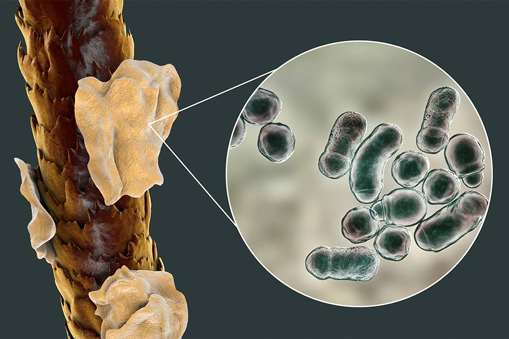 Человеческие волосы с перхотью и микроскопический грибок Malassezia furfur, вызывающих образование крупных чешуек. Источник: Kateryna Kon / Shutterstock
