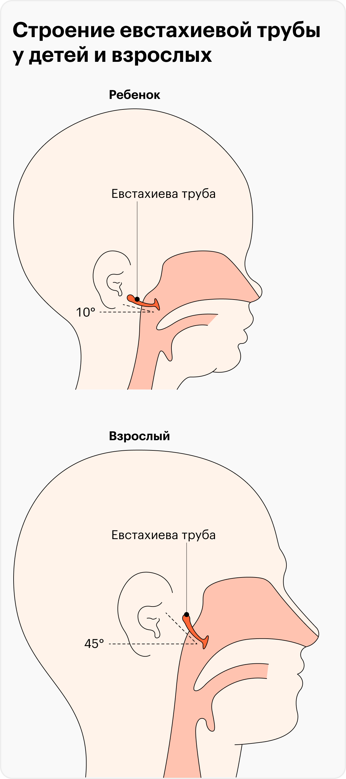 Как лечить отит наружного уха