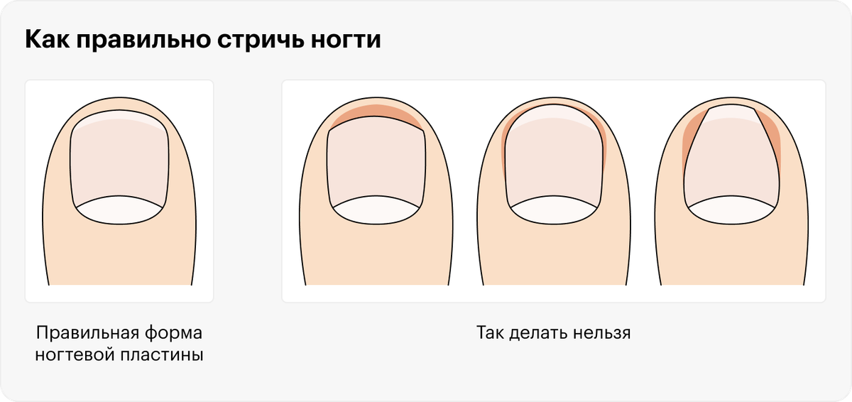 Вросший ноготь: что делать, причины, лечение без операции, осложнения ...
