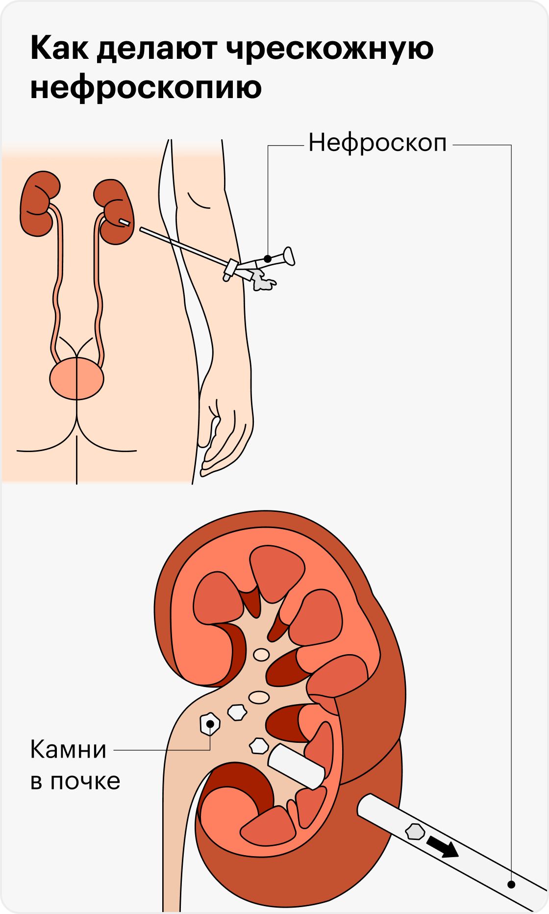 Дистанционная ультразвуковая литотрипсия. Экстракорпоральная ударно-волновая холелитотрипсия. Лазерная контактная литотрипсия камня мочеточника. Неинвазивная литотрипсия,. Аппарат для дробления камней в почках литотрипсия.