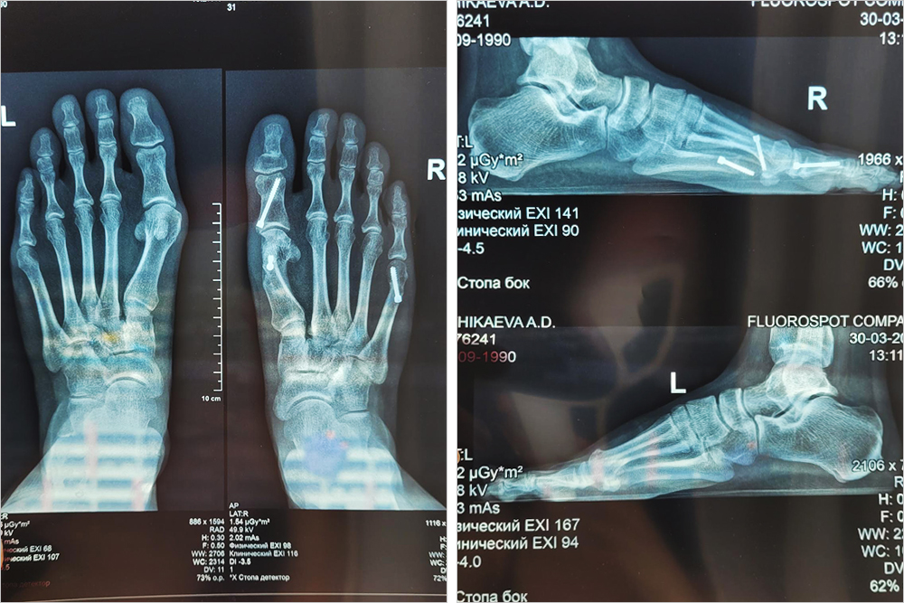 Вот так выглядит рентгеновский снимок стопы с винтами. Он сделан через три месяца после операции на правую ногу