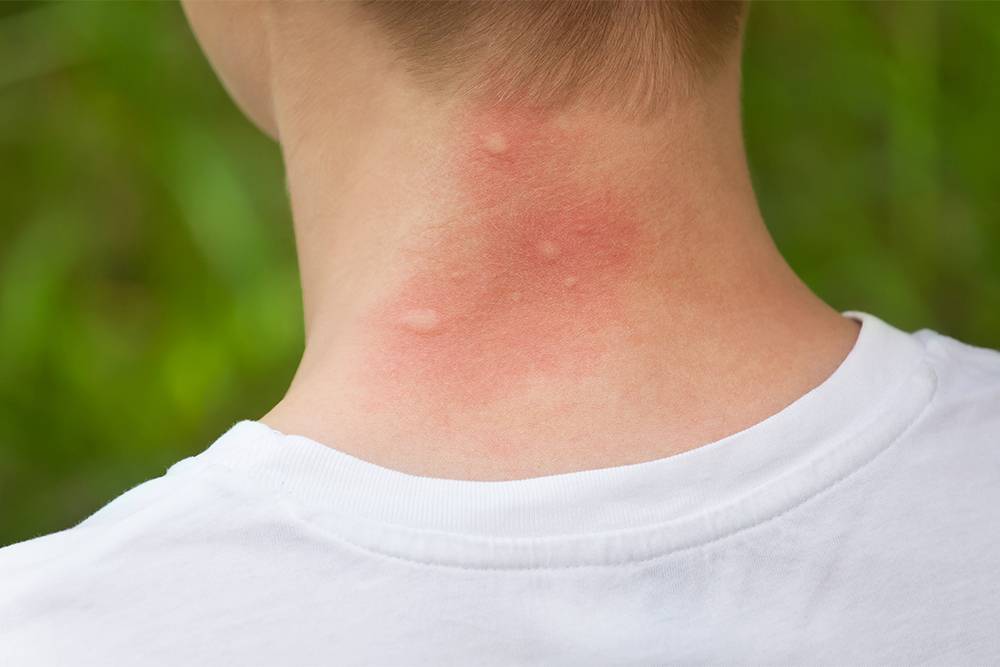 Свежий укус комара. Источник: dimid_86 / Shutterstock