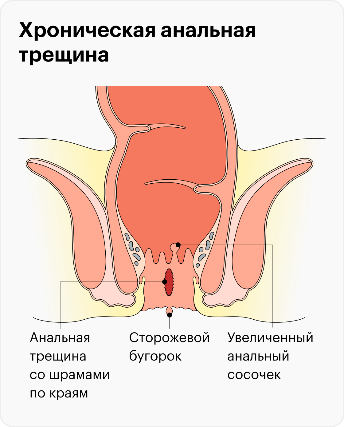 трещины анала при сексе фото 54