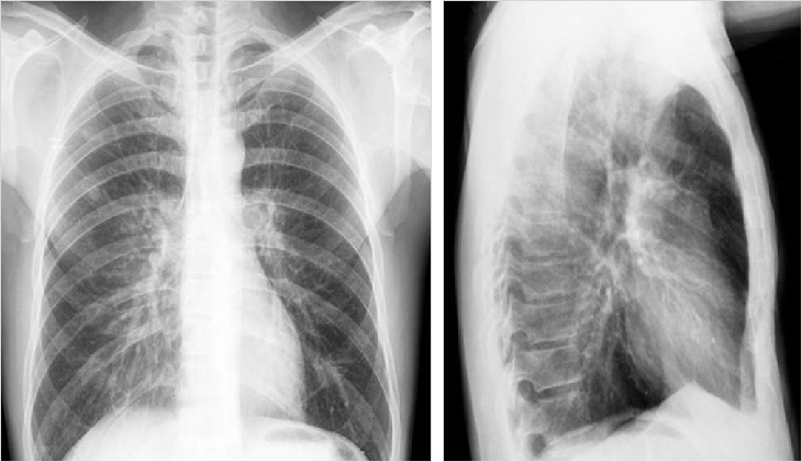 Рентгеновское изображение грудной клетки в задне-передней и левой боковой проекции. Источник: Researchgate