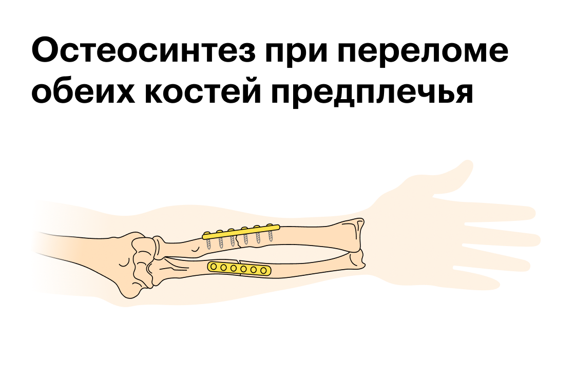 Остеосинтез при&nbsp;переломе обеих костей предплечья