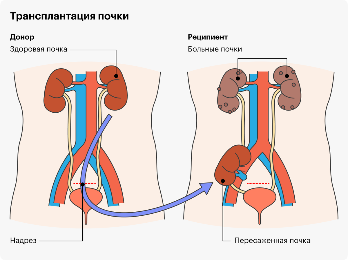 Почки после. Трансплантация почки схема. Трансплантация почки этапы. Гетеротопическая трансплантация почки.