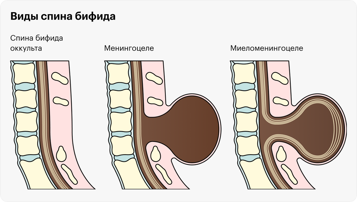 Ученые выделяют три вида расщепления позвоночника: спина бифида оккульта — когда в позвоночнике есть небольшой зазор, менингоцеле — когда из расщелины выступает спинномозговая оболочка с жидкостью, но спинного мозга в ней нет, и миеломенингоцеле — когда из расщелины выступает часть спинного мозга