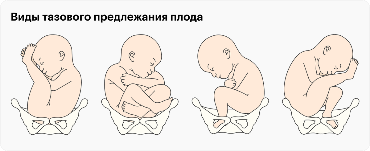 Первые роды через естественные родовые пути возможны при&nbsp;тазовом предлежании только в том случае, если младенец лежит в первом положении: точно ягодицами вниз с вытянутыми вверх вдоль тела ногами