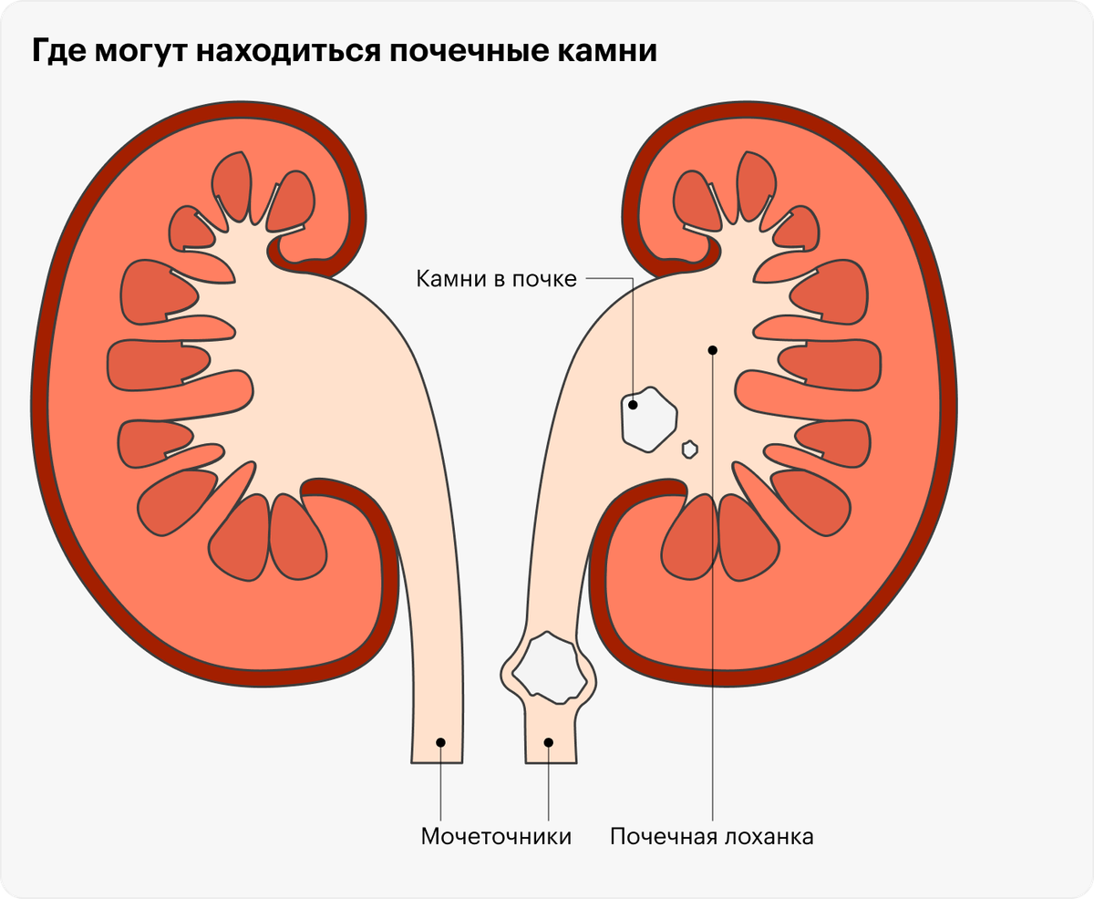 Камни в почках картинки