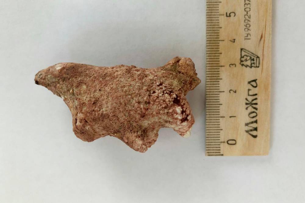 Удаление камней из почек: как проходит операция, сколько стоит, методы ...